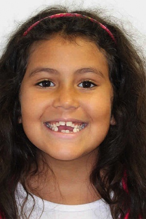 Young girl with misaligned smile before orthodontics