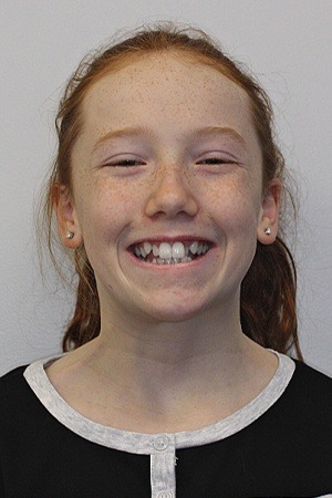 Young girl with crooked smile before orthodontics