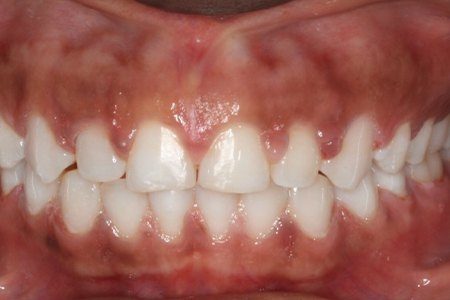 Closeup of smile aligned with braces