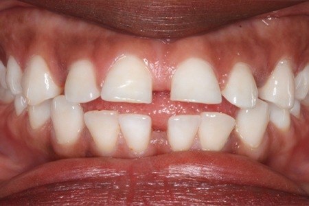 Closeup of smile with gaps between teeth