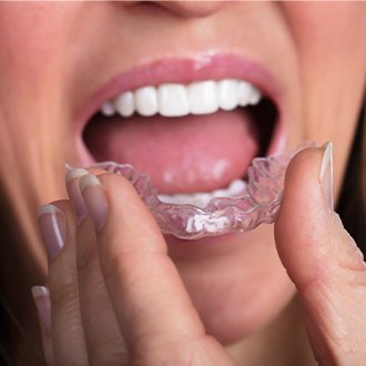 Closeup of patient placing clear aligner tray