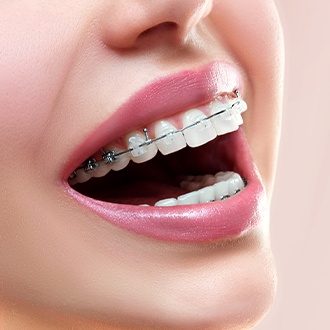 Closeup of smile with clear and ceramic braces