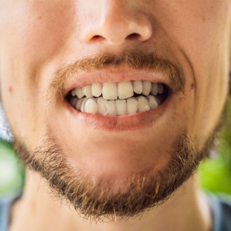 Closeup of smile with bite plate