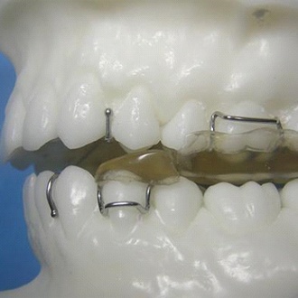 Model smile with a twin block appliance