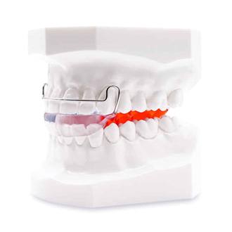 Model smile with Bionator appliance