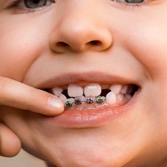 Closeup of smile with pediatric orthodontics