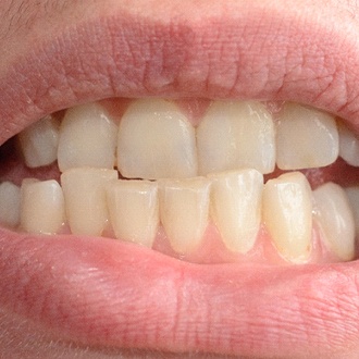 An up-close image of a person’s crowded teeth on the lower arch