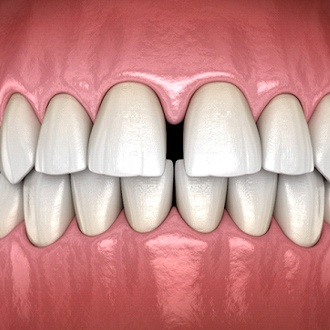 A digital image of a row of teeth with a large gap between the two upper front two teeth