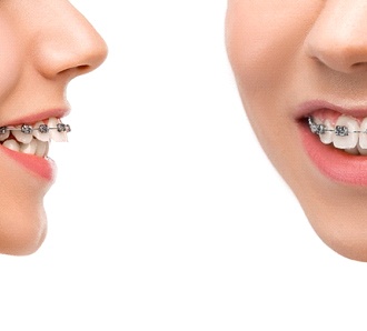 The side view of a person’s teeth who has an overbite but is wearing braces to fix the problem