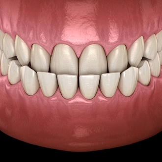 A digital view of what appears to be an underbite