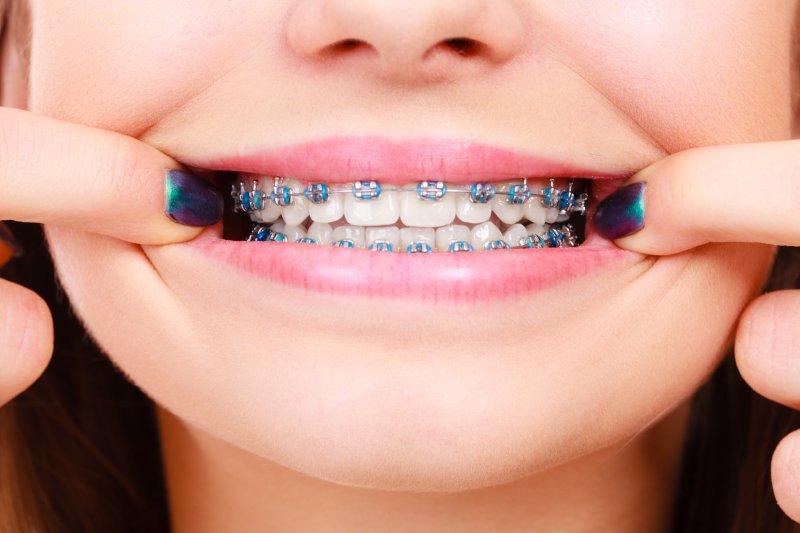 Closeup of girl showing her metal braces