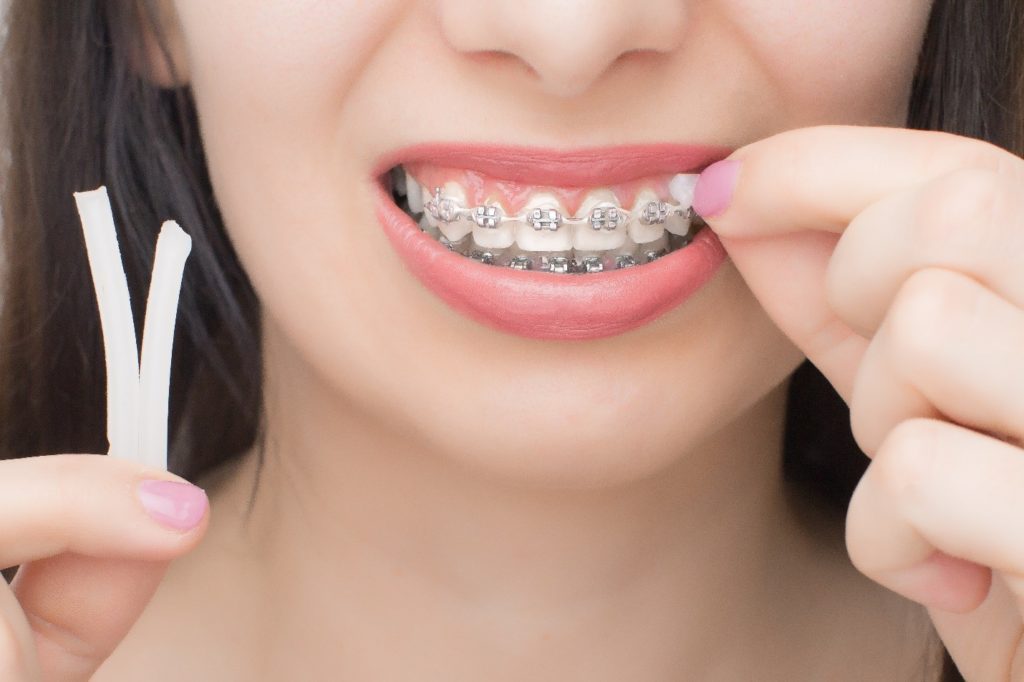 Closeup of woman applying dental wax to her braces