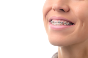 a closeup of a patient with braces smiling